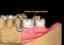 design partial dentures in exocad
